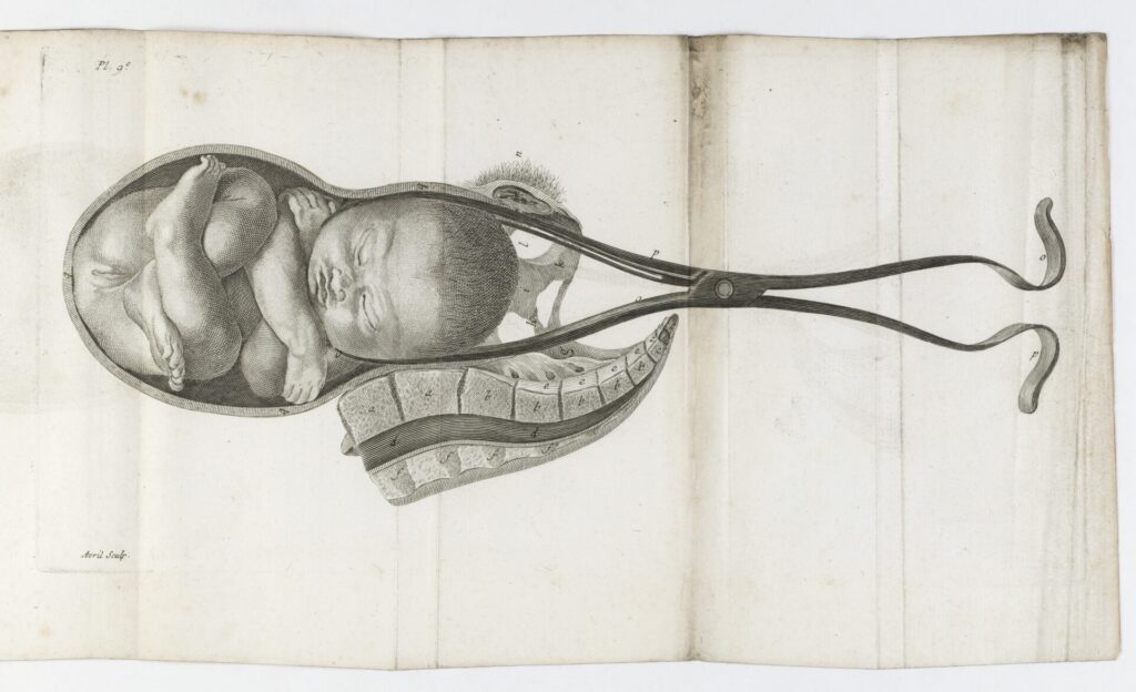 Plate showing the birth of a baby using forceps from L'art des accouchemens, by Jean Louis Baudelocque Published, 1781. (Wellcome Images)